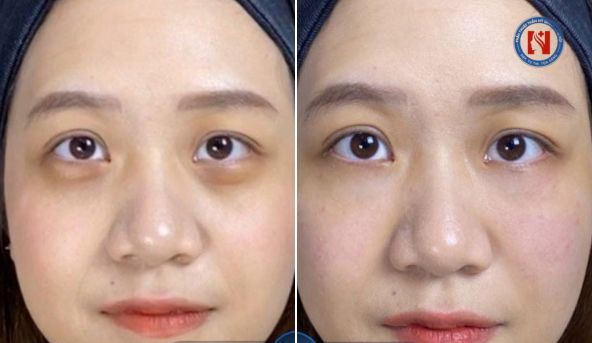Hình ảnh cắt mí dưới