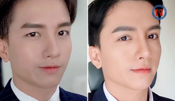 Hình ảnh cắt mí dưới
