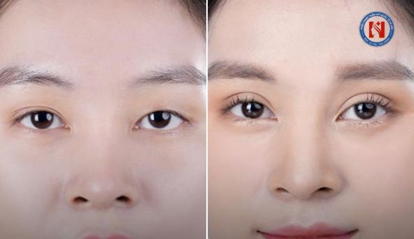 Hình ảnh sụp mí