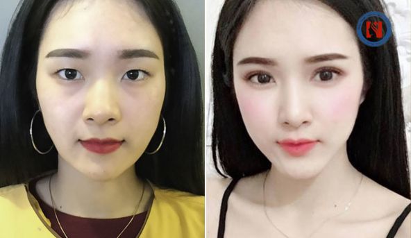 Hình ảnh sụp mí